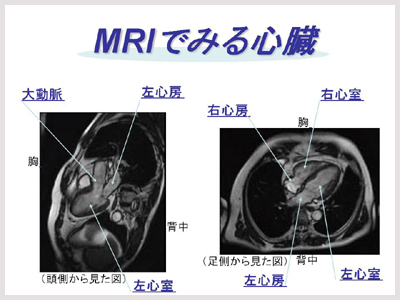 MRIで見る心臓
